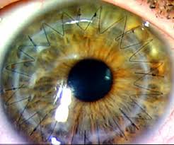 corneal transplant